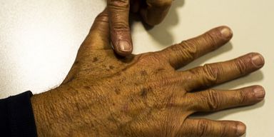 Conversa Saudável alerta para avanço do câncer de pele e riscos da desinformação sobre tratamentos dermatológicos