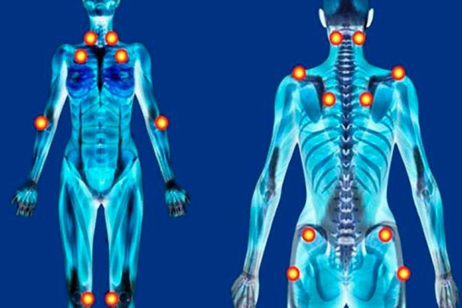 plfibromialgia