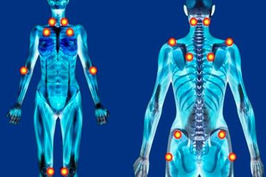 Projeto prevê tratamento da fibromialgia como política pública no Paraná
